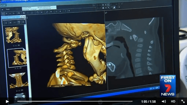 A contramarcha, cirugía médula espinal